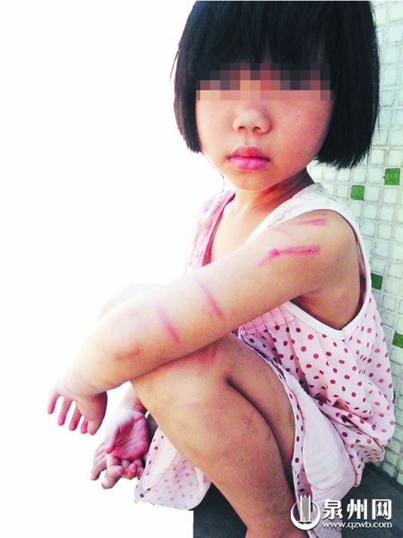 女孩身上伤痕累累 图片来源:东南早报
