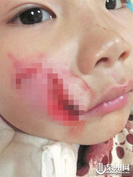 晋江一条恶狗咬伤女童脸 医生:伤口愈合将留疤